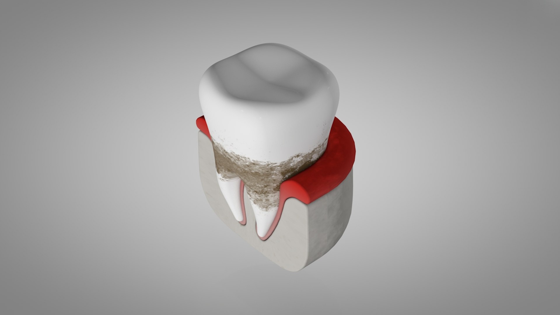 plaque tartar infection model https://p.turbosquid.com/ts-thumb/0P/Rdueje/2cxTdNO0/cenital/jpg/1599811577/1920x1080/fit_q87/45bc658780717e09e7a9bf5899f42416f1aa1a1a/cenital.jpg