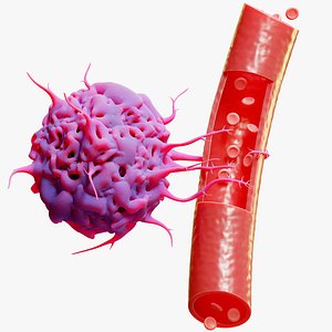 Vessel Tumor 3D model