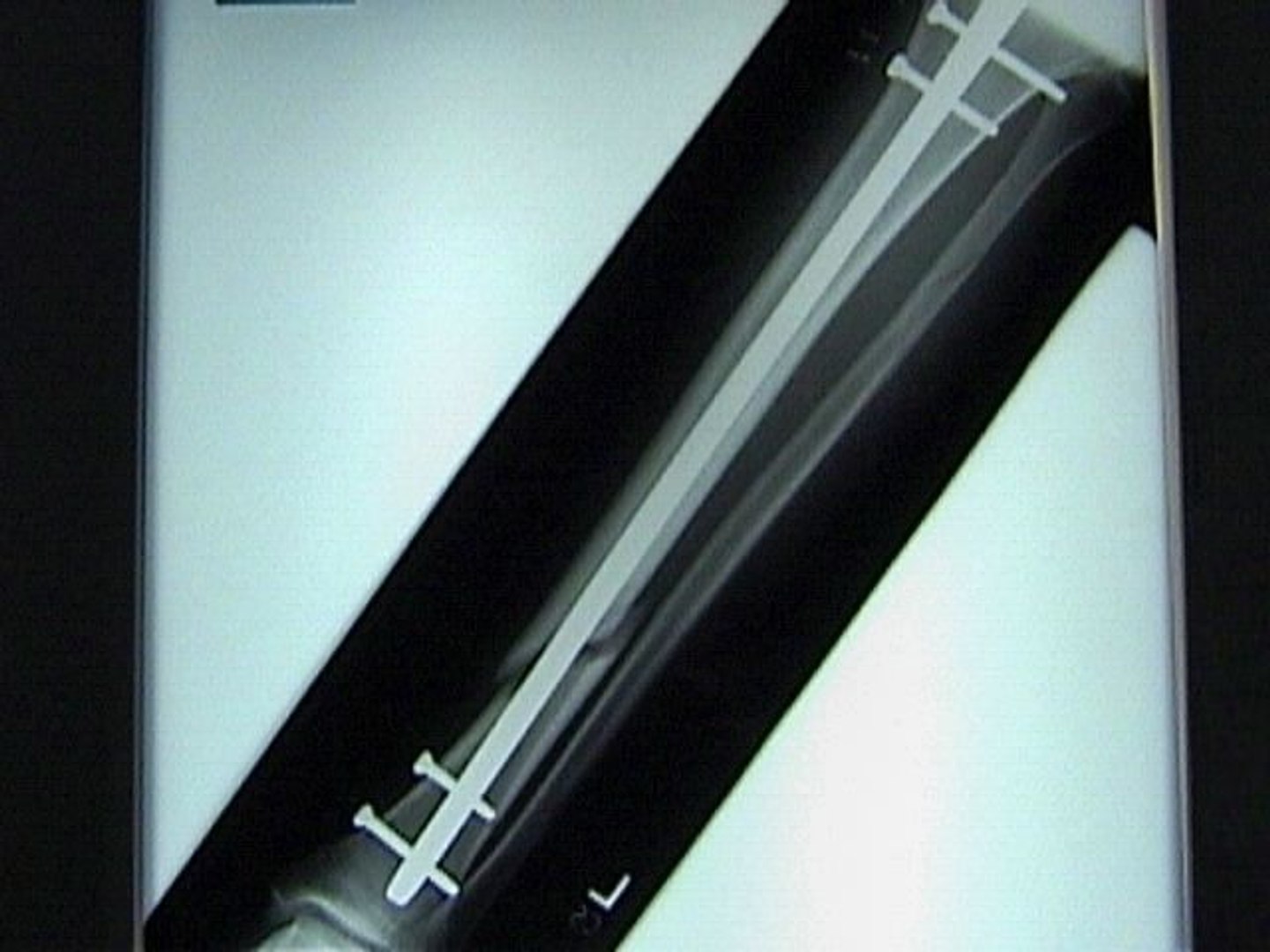 Tibial Nails 3D - TurboSquid 1578036