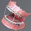 realistic dentition braces 3d max