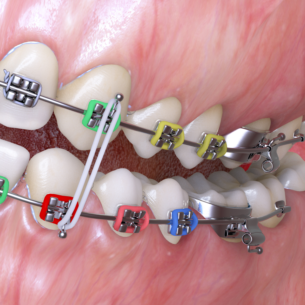 realistic dentition braces 3d max