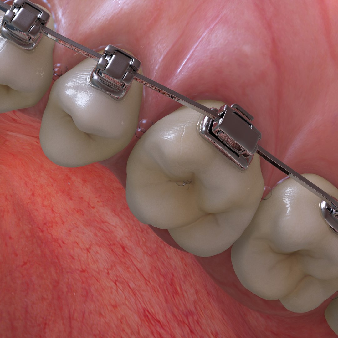 realistic dentition braces 3d max https://p.turbosquid.com/ts-thumb/0i/qVXpaE/LW2qDWSx/closeup_05/jpg/1409096337/1920x1080/fit_q87/605895b2f0162a13a79f69733801537beccc8af2/closeup_05.jpg