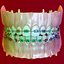 Dentizione permanente con bretelle
