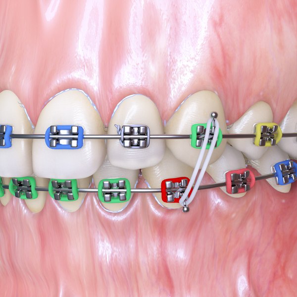 realistic dentition braces 3d max