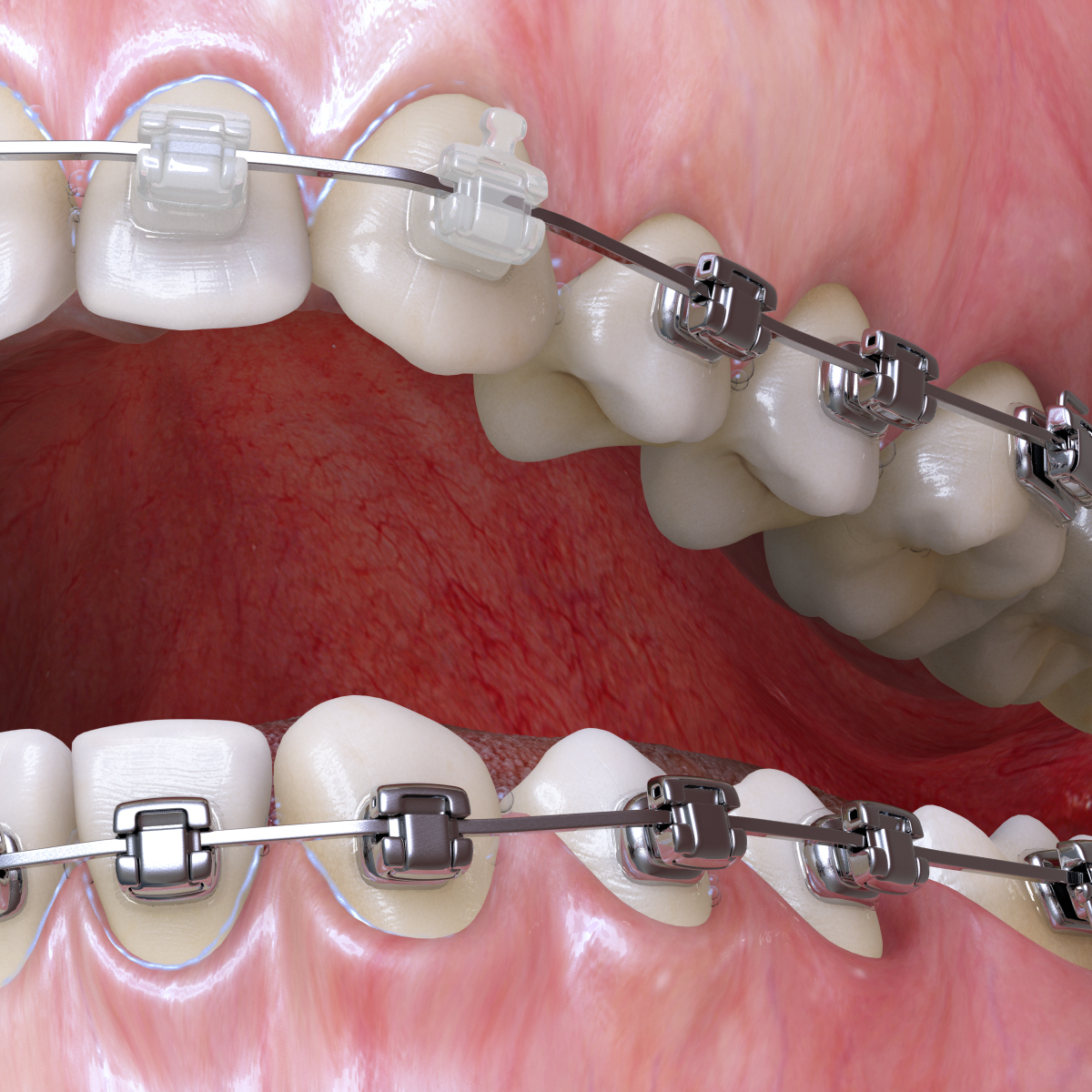 realistic dentition braces 3d max