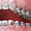 Dentizione permanente con bretelle