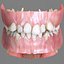 Dentizione permanente con bretelle