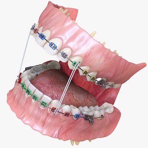 Permanent Dentition with Braces