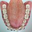 Dentizione permanente con bretelle