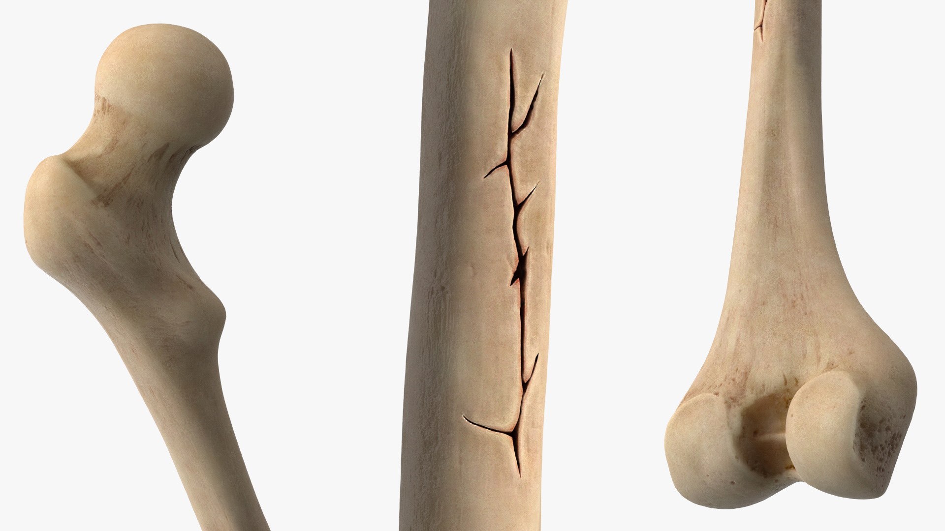 3D Human Femur Bone Anatomy https://p.turbosquid.com/ts-thumb/0r/d9NYAy/Xm/human_femur_bone_anatomy_006/jpg/1782796072/1920x1080/fit_q87/28b7a6f938362f754e14ea28b85502a12552857c/human_femur_bone_anatomy_006.jpg