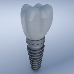 dental implant 3D model