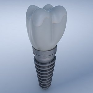 Dental Implant