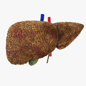 Cirrhosis Liver 3D
