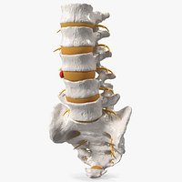 Spinal Column with Hernia