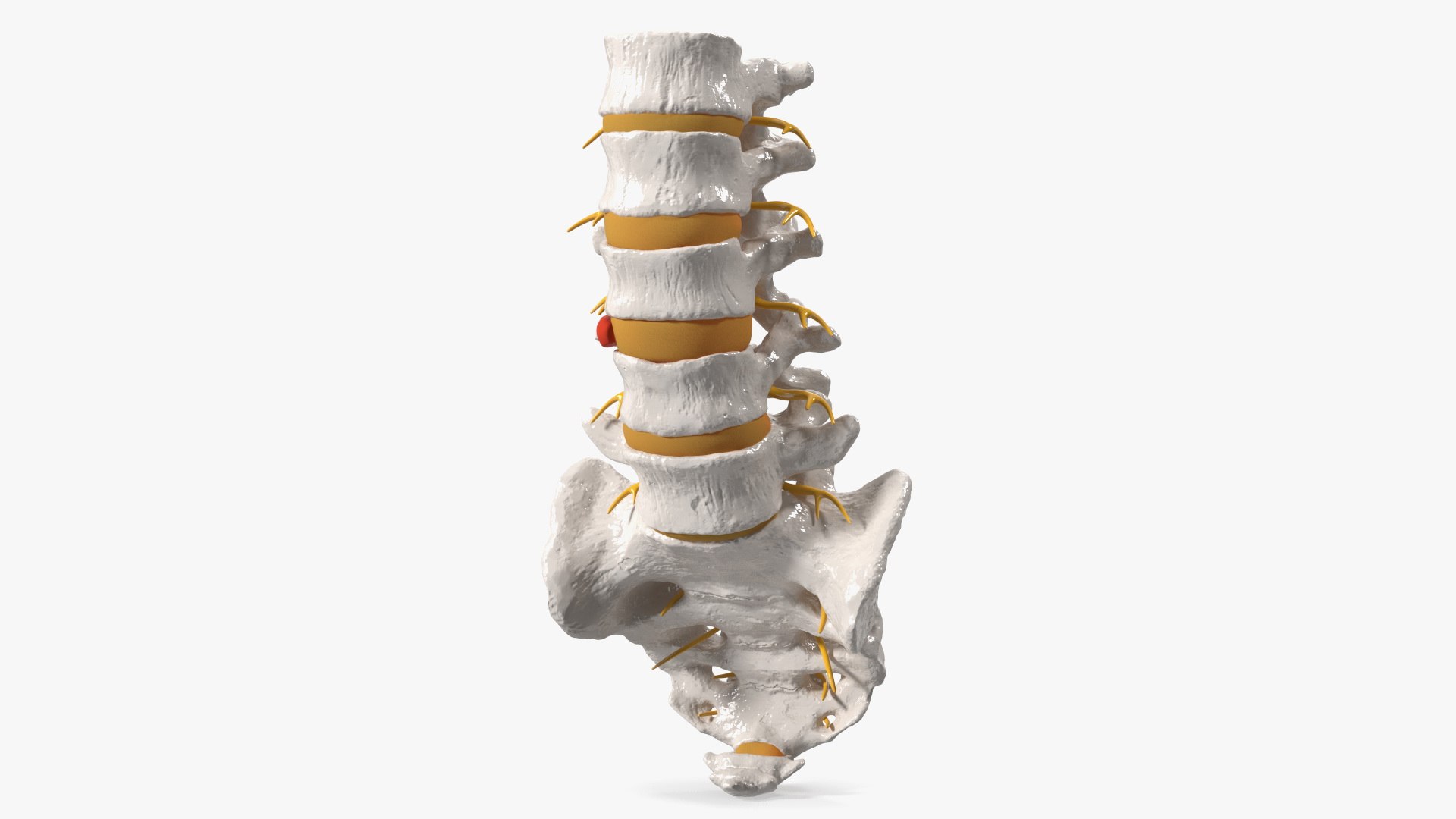 Spinal Column with Hernia 3D model preview