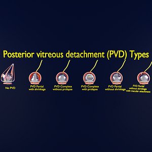 Posterior vitreous detachment types eye