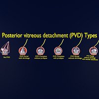 Posterior vitreous detachment types eye