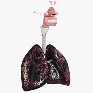 Respiratory System Smoker's Lungs heavy stage