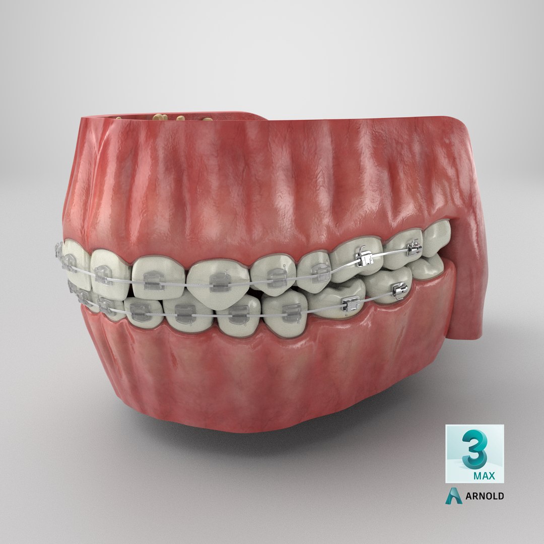 Human Mouth With Self Ligating Transparent Dental Braces V02 model https://p.turbosquid.com/ts-thumb/1e/DwIjGZ/AA/stemcell_max_arnold_render/png/1710086132/1920x1080/fit_q87/654388cfb3817c0ee88ed3e1a5d542cf73cbdcee/stemcell_max_arnold_render.jpg
