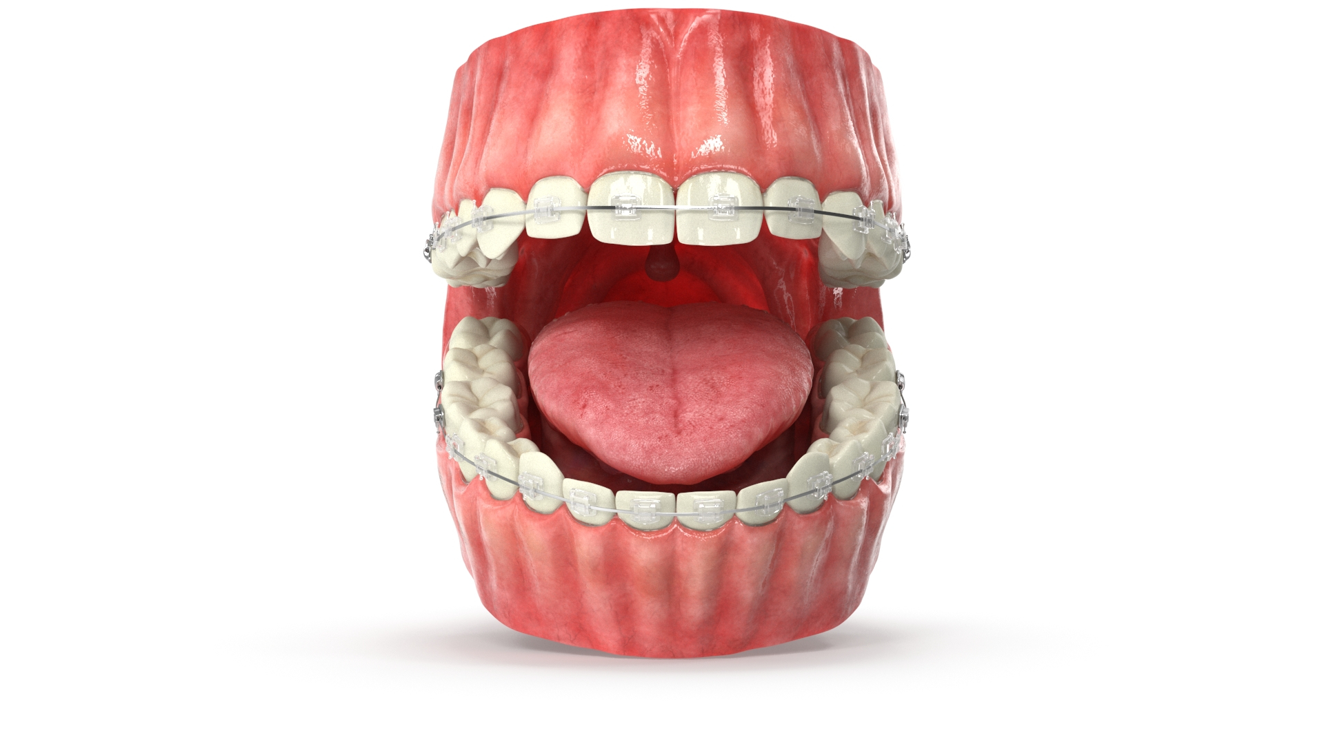 Human Mouth With Self Ligating Transparent Dental Braces V02 model https://p.turbosquid.com/ts-thumb/1e/DwIjGZ/Io/mouthselfligatingtransparentbraces_tuncoloropn/jpg/1709546113/1920x1080/turn_fit_q99/d6a94678850e8c799e5e73c2e315cb31954d3791/mouthselfligatingtransparentbraces_tuncoloropn-1.jpg