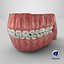 Human Mouth With Self Ligating Transparent Dental Braces V02
