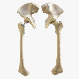 medical endoprosthesis 3d model