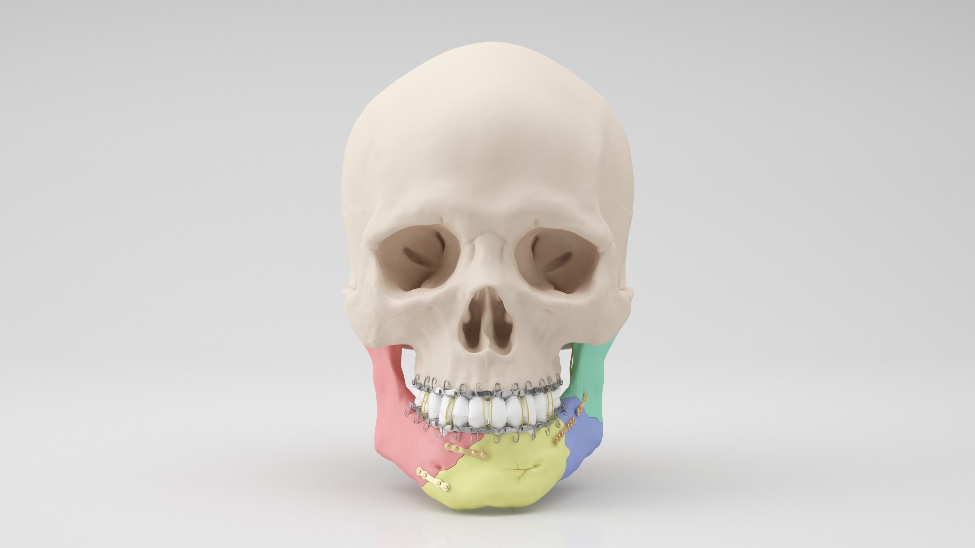 modelo 3d Cráneo masculino - Fractura de mandíbula - TurboSquid 2295422