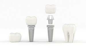 3D model Tooth Implants