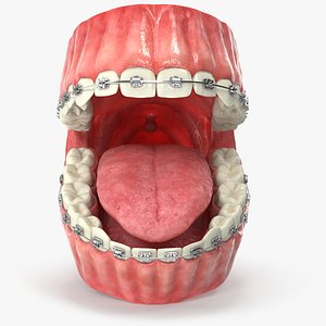Human Mouth With Self Ligating Steel Dental Braces V03