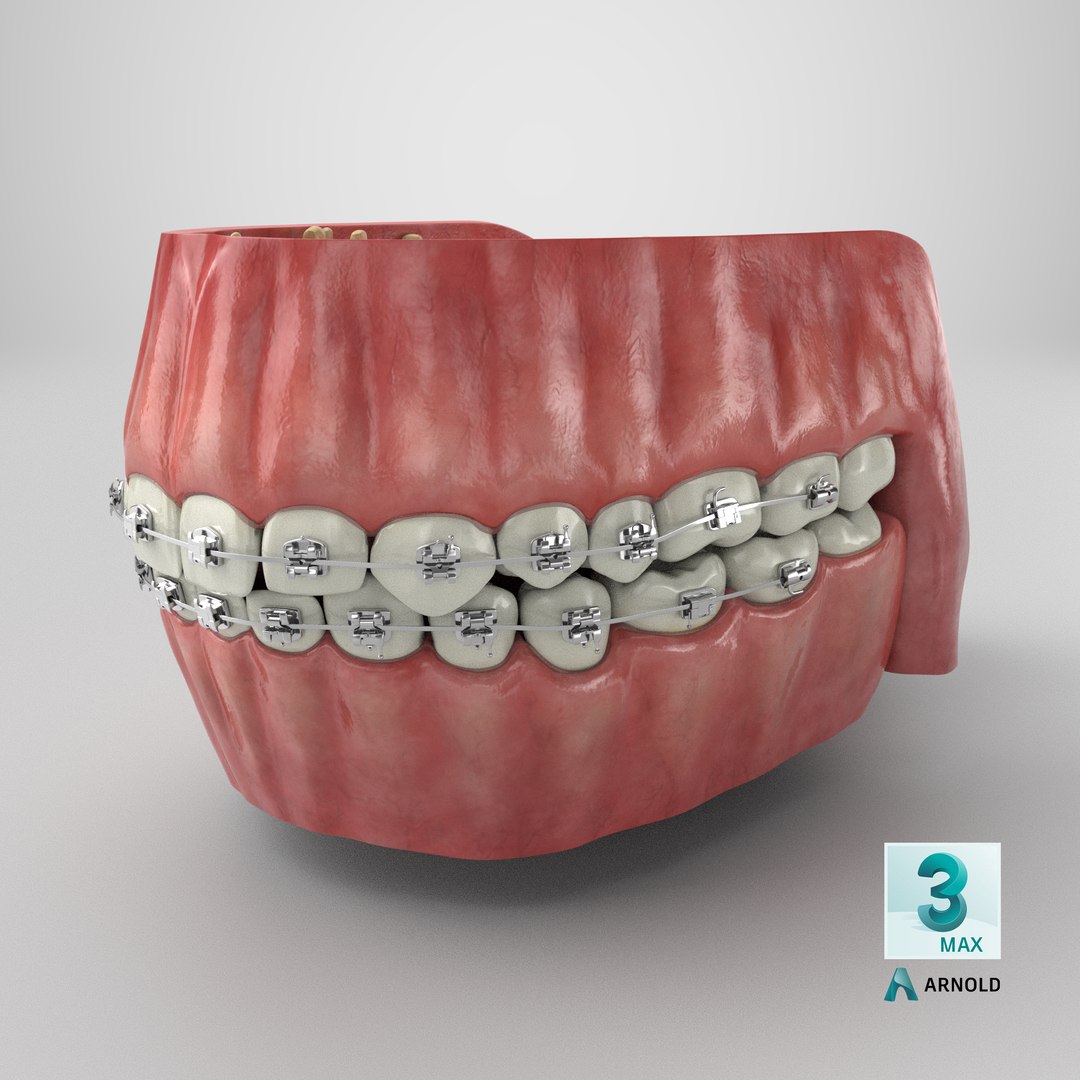3D model Human Mouth With Self Ligating Steel Dental Braces V03 https://p.turbosquid.com/ts-thumb/2N/dOumDw/f7/stemcell_max_arnold_render/png/1710845305/1920x1080/fit_q87/3f04d9e17cd84279c0f1100d31e488f5ca7e84f0/stemcell_max_arnold_render.jpg
