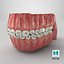 Human Mouth With Self Ligating Steel Dental Braces V03