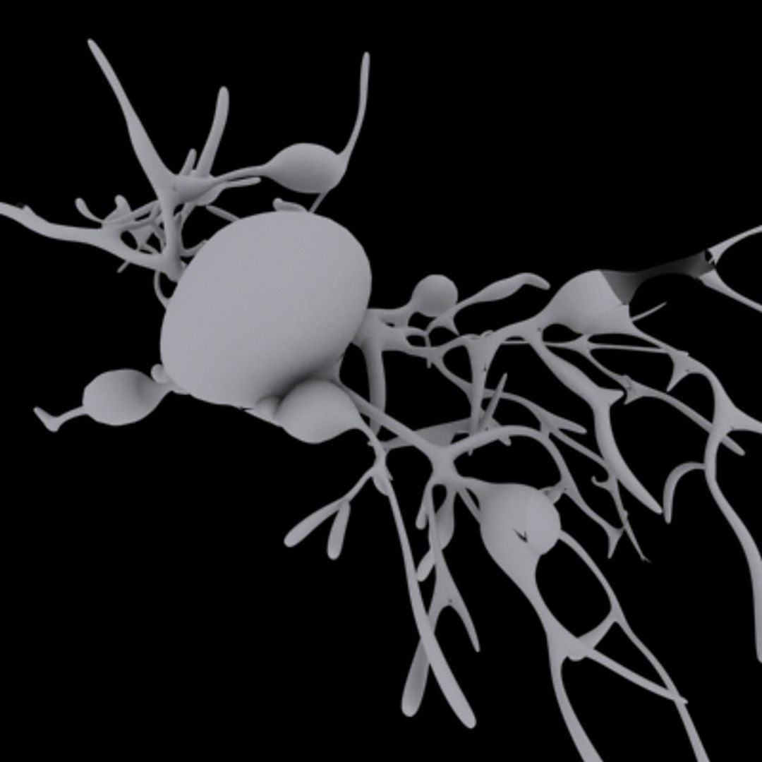 Brain Tumor 3d Model