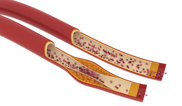 3D model blood vessel normal damages