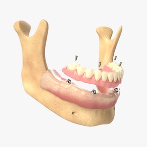 Denture with Dental Implants