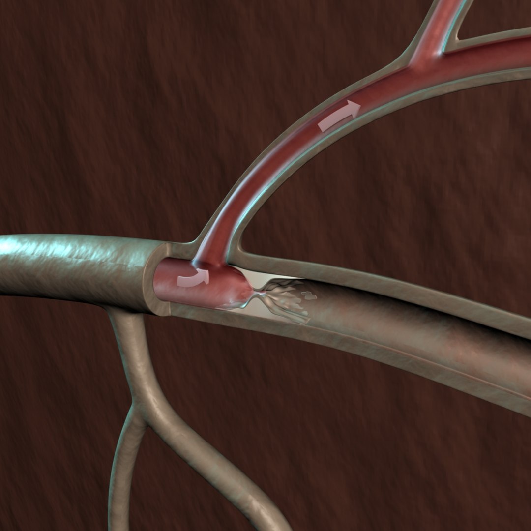 3d Model Blood Clogged Artery