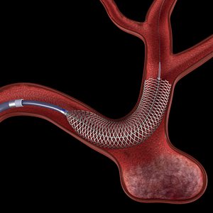 Flow diverter in aneurysm