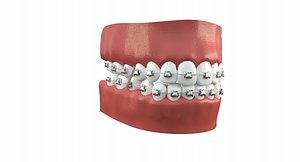 3D model teeth braces