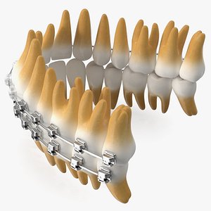 Ligature-Free Braces on Plastic Teeth