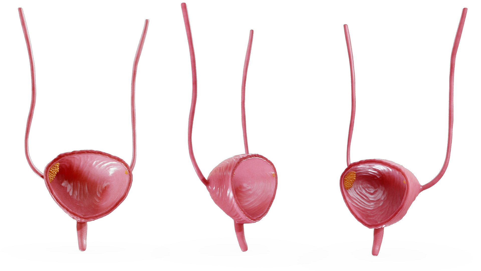 3D model Bladder Cancer Anatomy https://p.turbosquid.com/ts-thumb/43/ewYXNz/LA/bladder_cancer_render_1/png/1766094602/1920x1080/fit_q87/531f56cbe7613f6797abf7e3565fb43c34139757/bladder_cancer_render_1.jpg