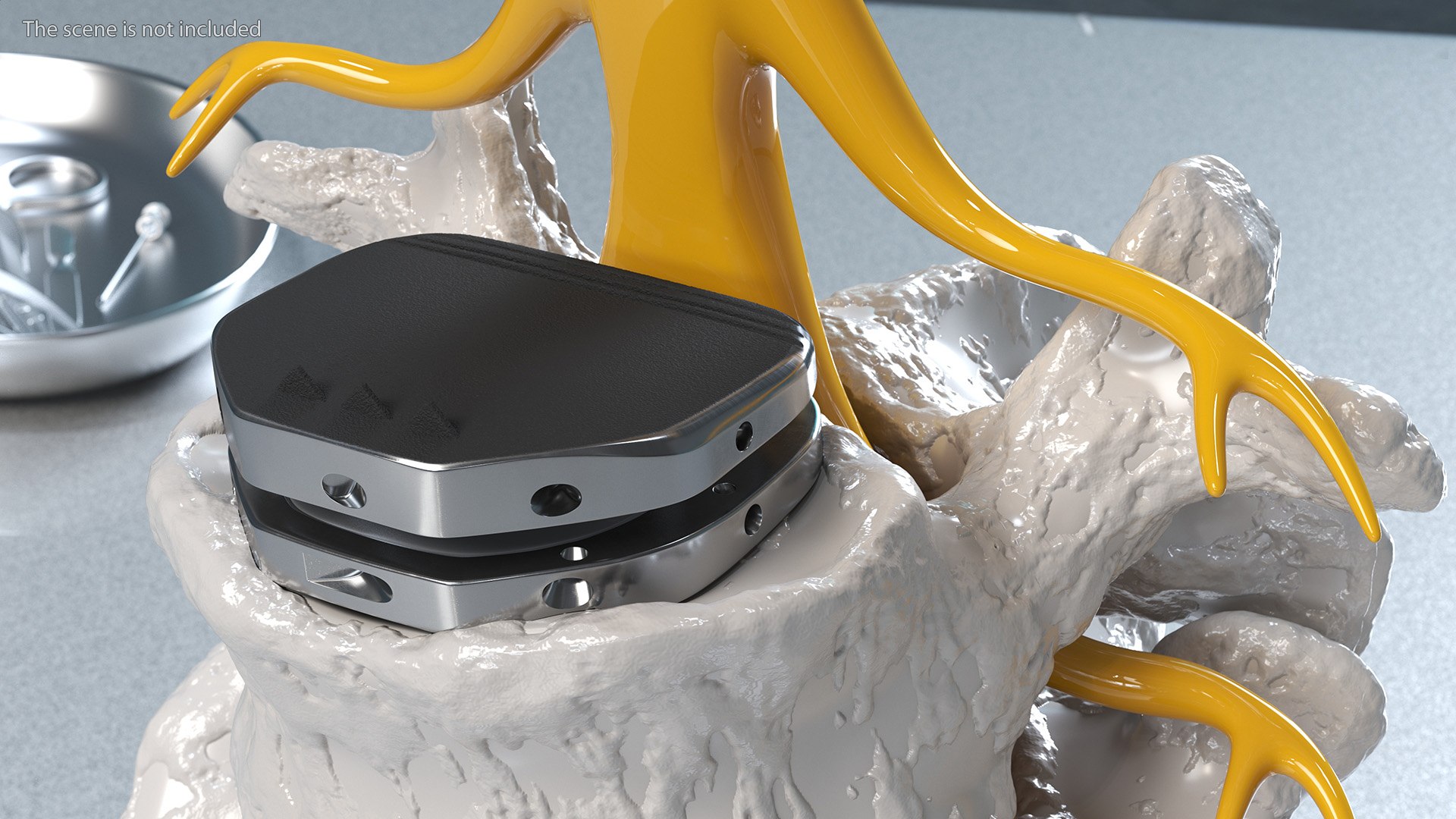 3D Intervertebral Disc Implant Installed on Spine https://p.turbosquid.com/ts-thumb/4G/6i9bTs/AD/intervertebraldiscimplantinstalledonspinec4dmodel007/jpg/1710696904/1920x1080/fit_q87/c37ccaf413b272d4c21f3ee6e539a1a3e898588b/intervertebraldiscimplantinstalledonspinec4dmodel007.jpg