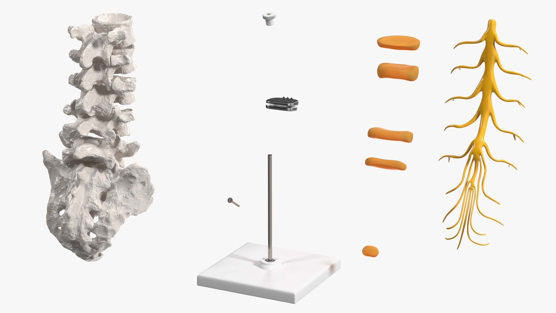 3D Intervertebral Disc Implant Installed on Spine https://p.turbosquid.com/ts-thumb/4G/6i9bTs/WU/intervertebraldiscimplantinstalledonspinec4dmodel015/jpg/1710696924/1920x1080/fit_q87/58d9591457d6374b0c66d6f98c836dc500d24f37/intervertebraldiscimplantinstalledonspinec4dmodel015.jpg