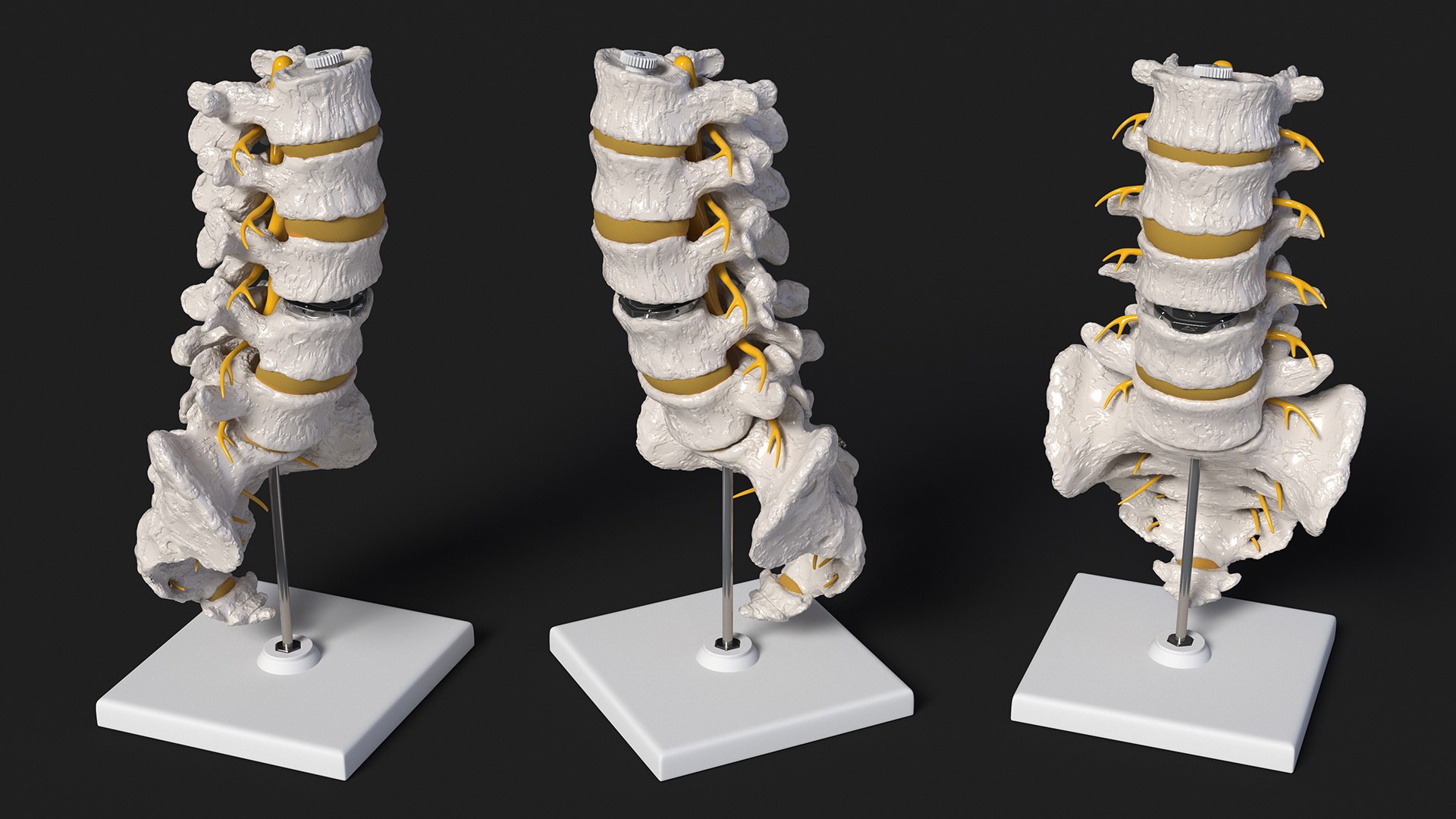 3D Intervertebral Disc Implant Installed on Spine https://p.turbosquid.com/ts-thumb/4G/6i9bTs/ci/intervertebraldiscimplantinstalledonspinec4dmodel011/jpg/1710696914/1920x1080/fit_q87/ed6f8aaafe3dbe63f5e1ff08ad520cf2d82ba6e4/intervertebraldiscimplantinstalledonspinec4dmodel011.jpg