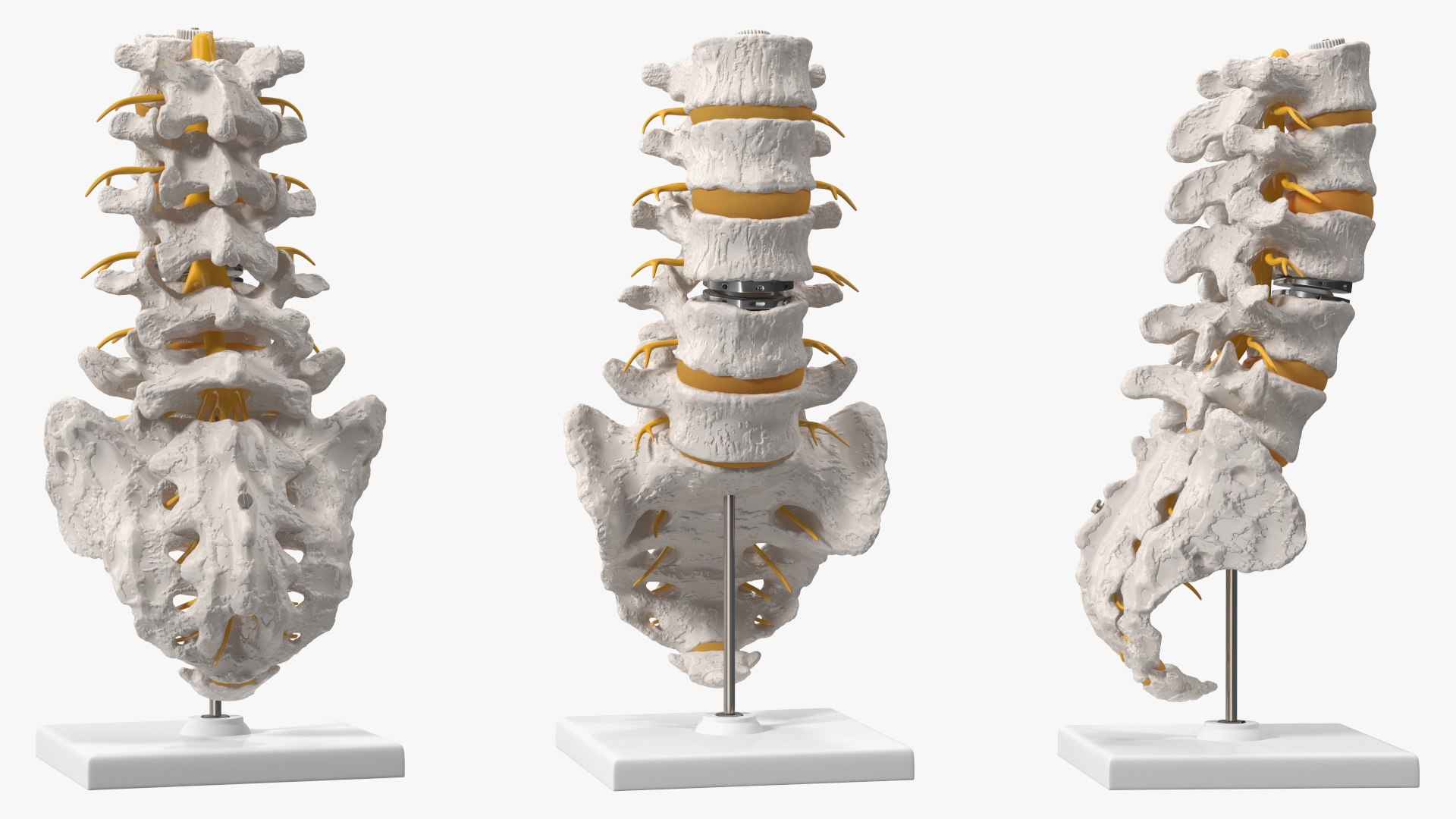 3D Intervertebral Disc Implant Installed on Spine https://p.turbosquid.com/ts-thumb/4G/6i9bTs/pE/intervertebraldiscimplantinstalledonspinec4dmodel012/jpg/1710696917/1920x1080/fit_q87/df569508297f9d88fb93aa10f7af0783e093edd4/intervertebraldiscimplantinstalledonspinec4dmodel012.jpg