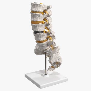 Intervertebral Disc Implant Installed on Spine