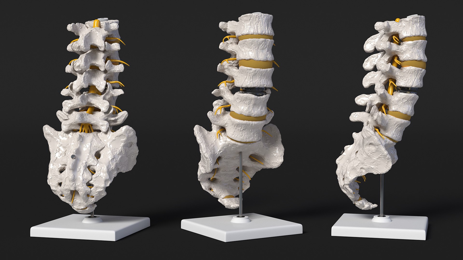 3D Intervertebral Disc Implant Installed on Spine https://p.turbosquid.com/ts-thumb/4G/6i9bTs/zb/intervertebraldiscimplantinstalledonspinec4dmodel010/jpg/1710696911/1920x1080/fit_q87/7764c513c185ec23860be0c63b17c14090f68257/intervertebraldiscimplantinstalledonspinec4dmodel010.jpg