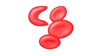Sickle cell anemia