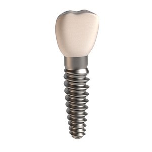 3d dental implant