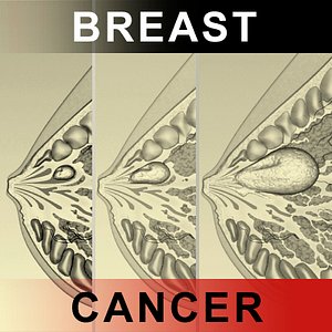 Breast Cancer Laps