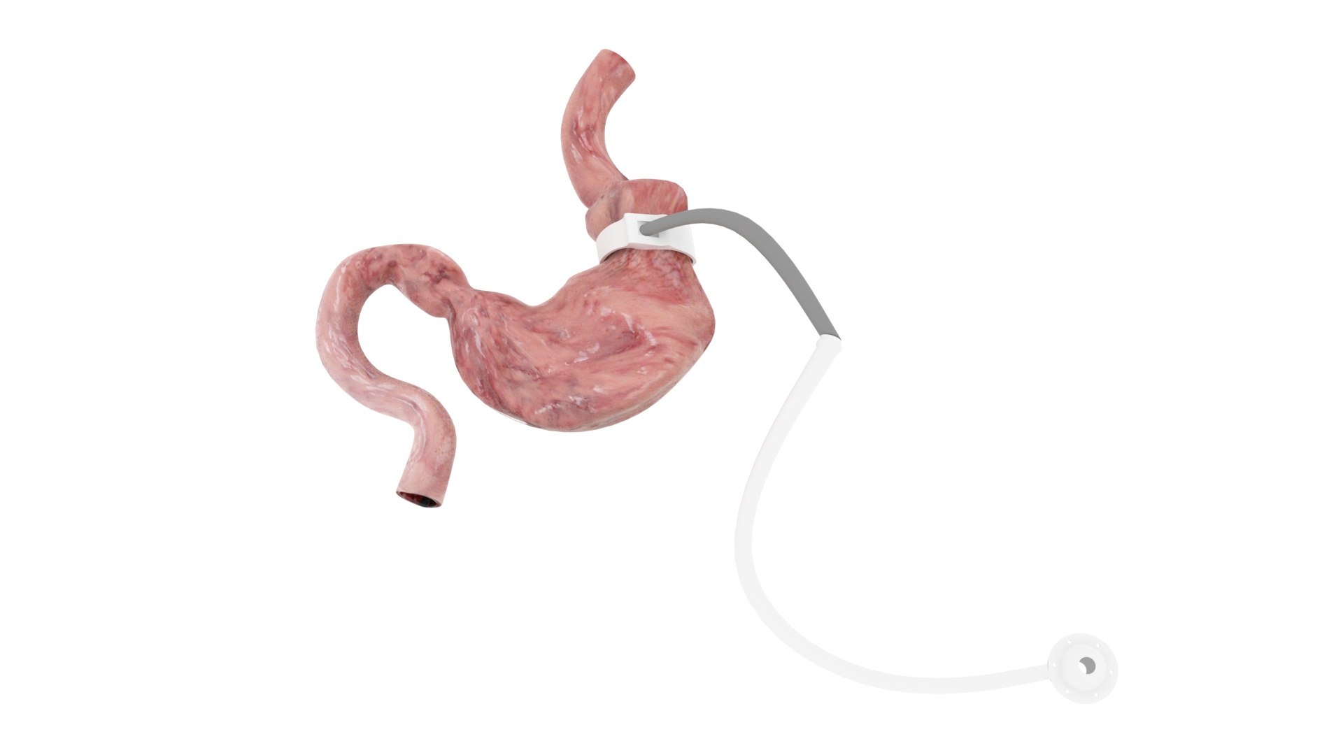 3D Stomach With Stomach Band Model - TurboSquid 2282307