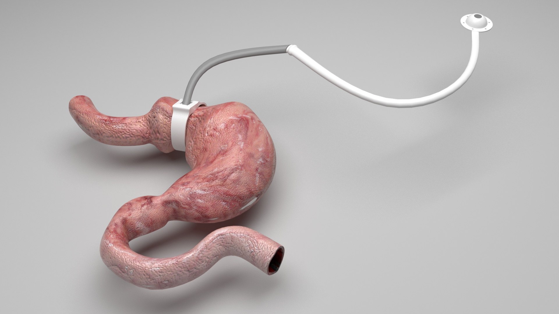 3D Stomach With Stomach Band Model - TurboSquid 2282307